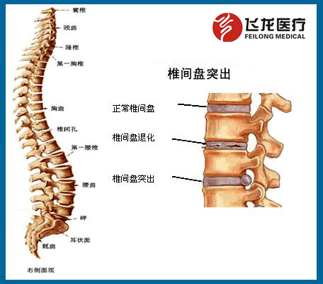 椎間盤(pán)突出癥狀