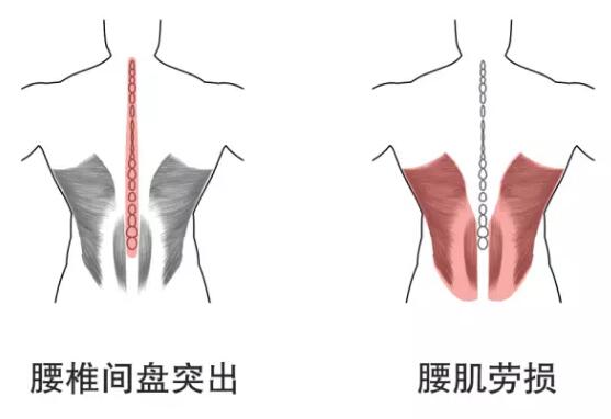 腰椎間盤(pán)突出腰肌勞損